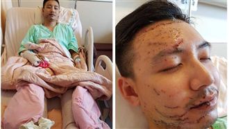 國道警首露面！縫400針靠嗎啡止痛