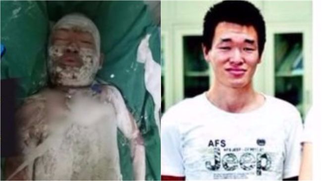 他全身灼傷！　擔心拖累家人求安樂死