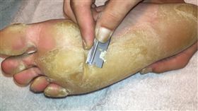 腳皮,繭,長繭,角質／YouTube