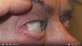 瞼裂斑▲圖／翻攝自YouTube