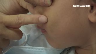 6歲女童臉紅腫瘀青　疑幼兒園師施暴