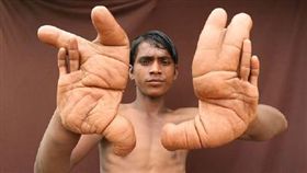 印度,塔理克,Tarik,怪病,大手,怪手（圖／翻攝自微博）