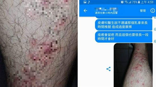 按摩紓壓…隔天腳卻嚴重「化膿發炎」