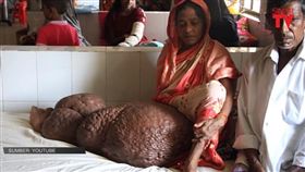 孟加拉,女子,象皮病（圖／翻攝自《Sinar TV》YouTube）
