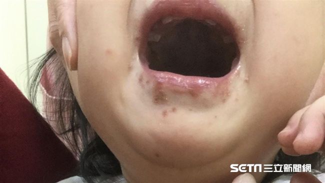 水泡包圍1歲半女童唇　姊姊也中標