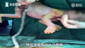 中國大陸,胎兒,臍帶扭轉(微博)