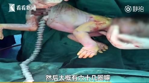 胎兒臍帶扭轉61圈　醫師剖腹嚇壞