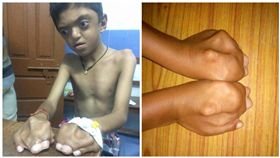 印度,男童,罕見疾病,亞伯氏症,四肢指頭黏在一起（圖／翻攝自milaap募資平台）
https://milaap.org/fundraisers/Save-Aswanth?utm_source=whatsapp&utm_medium=thank_you