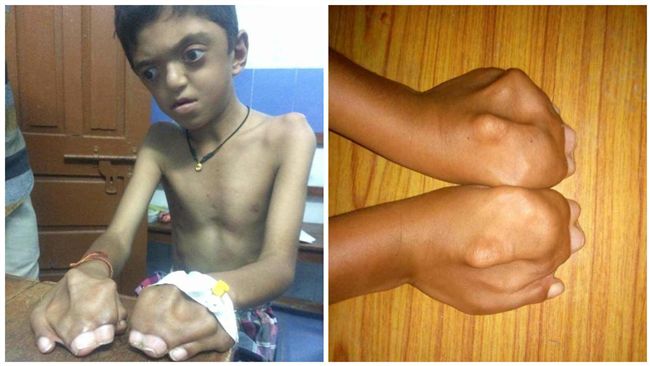 四肢指頭全黏住…8歲男童遭怪病纏身