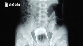 肛門塞直徑7cm玻璃杯　卡2天拿不出！醫生問原因…已婚男不解釋

圖／翻攝自《看看新聞》