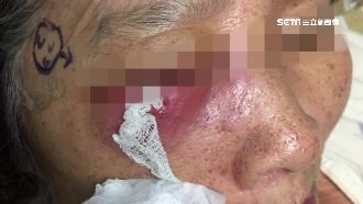 蛀牙痛七天　眼睛蜂窩性組織炎險失明