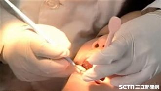 缺牙超過14顆　北榮研究：失智風險高10倍