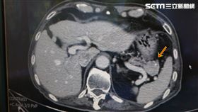 成因不明、無從預防　翁罹賈伯斯病