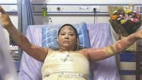 大陸,四川,女子燒傷（圖／翻攝自微博）