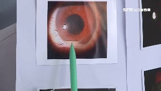 熱天不開冷氣！工人竟罹虹彩炎險失明