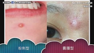 手癢好想擠！博士專業破解擠痘迷思
