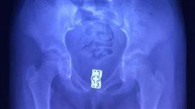 中國大陸,女童,下體,陰道,髮夾,異物,流膿,臭味（圖／翻攝自看看新聞）http://www.kankanews.com/a/2017-09-11/0038148178.shtml