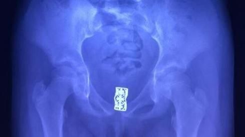 下體卡髮夾…女童3年不斷發臭又流膿