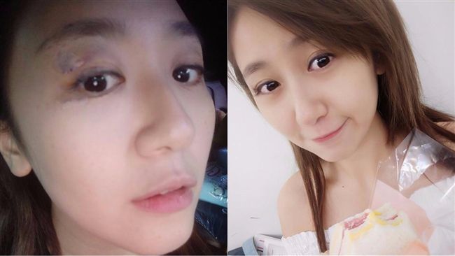 頭破血流還自拍？女星：我家沒鏡子
