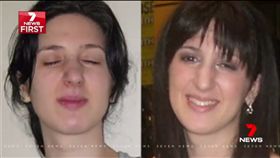 阿德勒,Natalie Adler染怪病,眼睛自動閉合(7news 推特 )