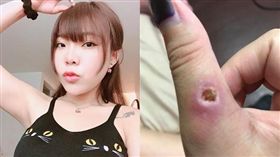  章魚好毒！　宛宛兒「肉長不回來」留一個膿包洞（圖／翻攝自宛宛兒臉書）