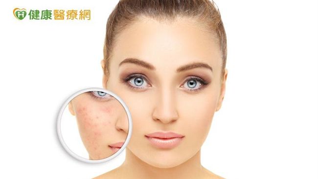 酒糟肌慢性泛紅　可用染料雷射來調理