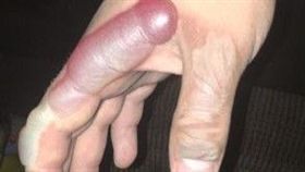 美國,網路,網友,消防員,燙傷,照片,Aaarms55 圖／翻攝自Imgur