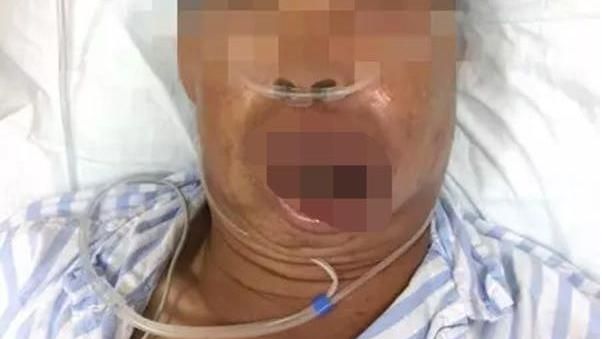 他擠破上唇一顆痘　連接兩張病危通知