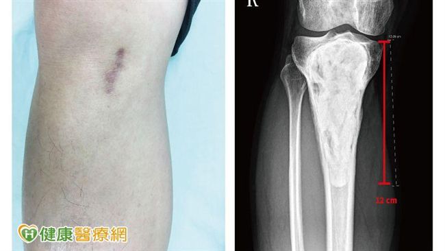 腳踝腫痛莫輕忽　恐因罕見骨腫瘤惹禍