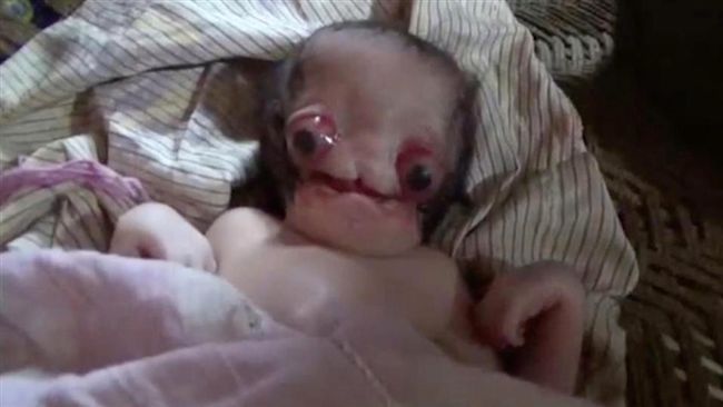 男嬰眼凸、無耳鼻　外星模樣嚇壞眾人