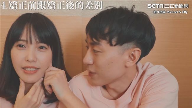 想變瓜子臉嗎？戴牙套前必看5個問題