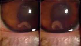 寄生蟲,墨西哥,Guzman Salas,虹膜,視網膜,眼睛,損害,失明,鑽洞,感染　圖／翻攝自NEJM臉書影片　https://goo.gl/JdvKqM