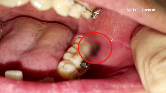 主治醫未操刀？女拔智齒傷口潰爛腐臭