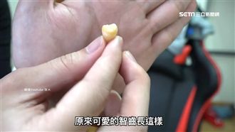 拔智齒可變小V臉？醫生破除迷思