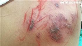 傳李新飽受「皮蛇」折磨　醫師：確實讓人痛苦不堪（圖／成大醫院）