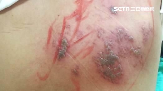 皮蛇折磨李新　醫：確實讓人痛苦不堪