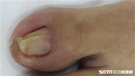 矯正前－病人大腳趾內嵌，越剪越痛，甚至常常出血。（圖／萬芳醫院提供）