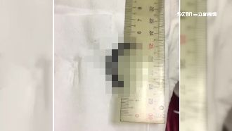 玩水後常流鼻血　少年鼻腔中驚見水蛭