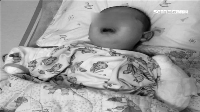 「鬼病」嬰無生殖器！父母忍痛殺畸兒