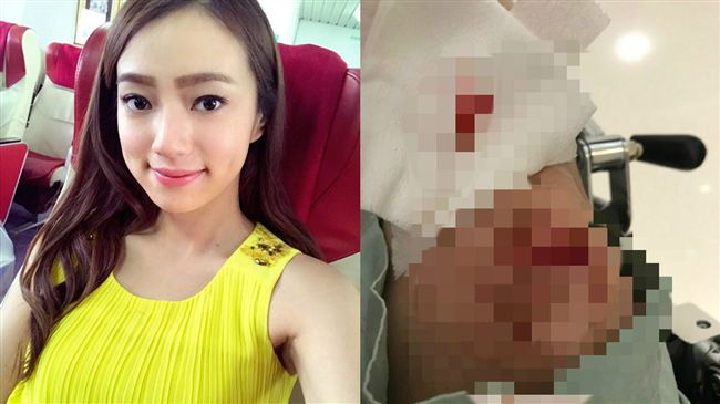 慎入！女星手扶梯慘摔「肉削一大塊」