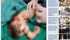 寄生胎,少年,頭髮,死胎(每日郵報 )