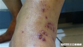 一名40多歲女子膝蓋、關節麻、抽痛，看了復健科、骨科均未改善，最後至皮膚科求診才檢查出是罹患帶狀皰疹所致。（圖／台北醫學大學附設醫院提供）