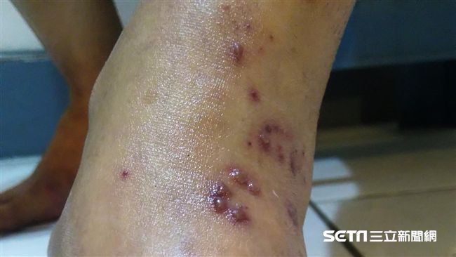 關節痛看骨科沒效　竟是「皮蛇」纏身