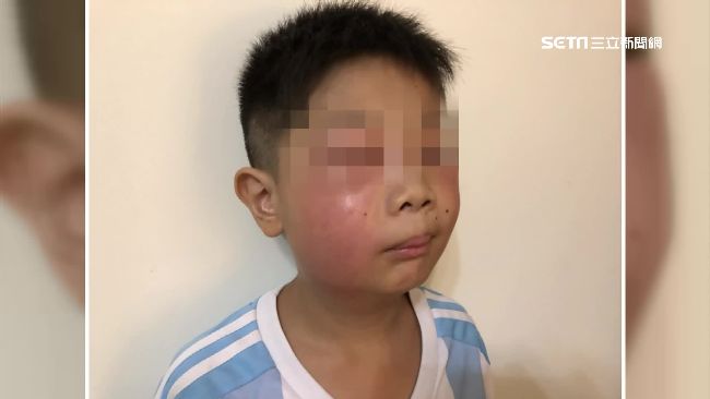 男童遭蜂螫　母合成麵包超人照片自嘲