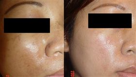 王太太才踏入診間就立刻跟醫師說：｢我要打雷射！｣經醫師追問及檢查，原來王太太被兩頰上密布的黃褐斑困擾多年，這些黃褐斑就是俗稱的「肝斑」。
成大醫院提供