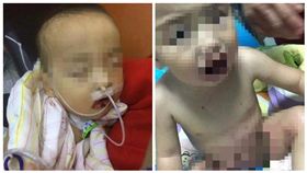 氫氧化鈉當糖…男童口腔灼傷發黑　奶奶水沖「下體也灼傷」
圖/翻攝自齊魯網