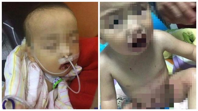 氫氧化鈉當糖吃　男童口腔灼傷發黑