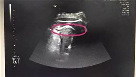 中國大陸,孕婦被胎兒踢破子宮,超音波圖(圖/微博)