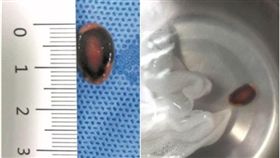 安徽5歲女童肺部藏瓜子咳不停（圖／翻攝自網路）