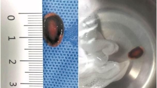 5歲女童咳2年　竟是肺藏瓜子惹的禍